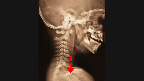 A Young Man Stuck A Fish Bone in his Throat. This is What Happened to his Organs.