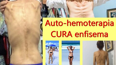 AUTO-HEMOTERAPIA CURA ENFISEMA. Relato de caso com registro fotográfico