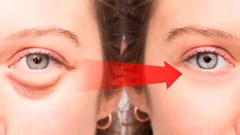 How to Get Rid of Puffy Eyes, Swollen Eyelids & Dark Circles