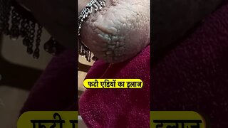 फटी एडियों का इलाज | fati ediyo ka Desi ilaj #shorts