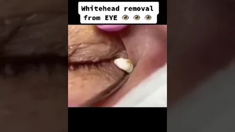 Must be very precise !! Whitehead Removal from Eye