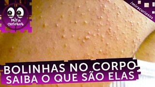 Saiba o que são estas bolinhas que aparecem no corpo. Mas já adianto, vem dos pais