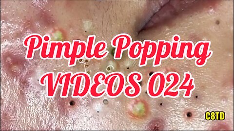 Satisfying Pimple Popping Videos 024