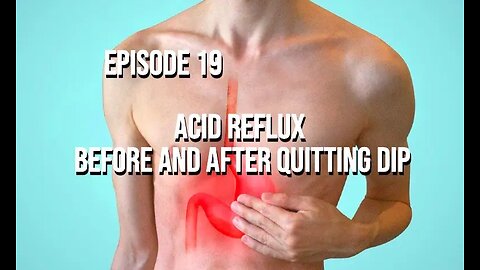 Acid Reflux Before and After Quitting Dip - Episode 19