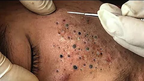 Extreme blackhead removal oddly satisfying video Episode # 2