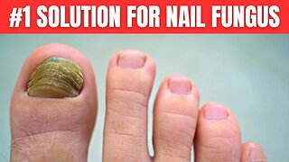 You Need Only 2 Ingredients To Get Rid of Nail Fungus Completely