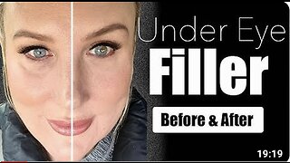 Under Eye Filler // Before & After