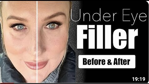 Under Eye Filler // Before & After