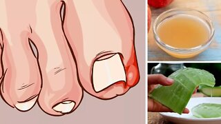 5 Home Remedies for Ingrown Toenails That Really Work