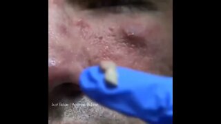 Curta o Êxtase do Momento - Remove Squeezing Blackheads and Pimples - Just Relax | Apenas Relaxe