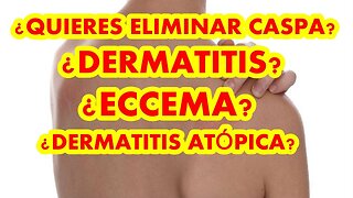 BINAURAL PARA DERMATITIS, ECCEMA, CASPA, PITIRIASIS, DERMATITIS ATÓPICA