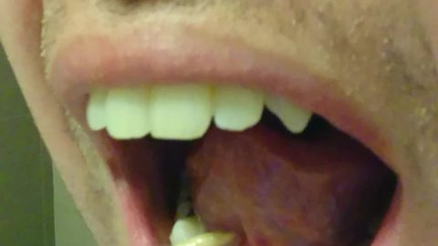Salivary Stone Squeezed Out of Tongue