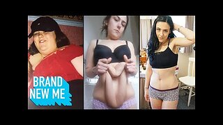 I Lost 140lbs And Finally Had My Extreme Excess Skin Removed | BRAND NEW ME