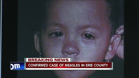 Confirmed case of measles in Erie County