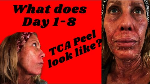 What Does Day 1 -8 TCA Peel 20% Look Like?