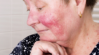 Skin Conditions That Are Commonly Mistaken for Acne