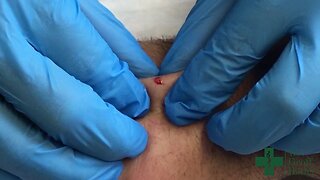 Drainage of a Ganglion Cyst on the Dorsum of the Wrist