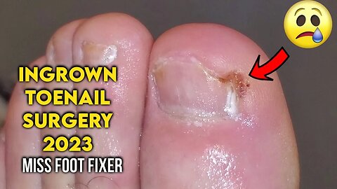 Ingrown Toenail Surgery 2023 [ Cutting Out Nail ] Full Treatment By Miss Foot Fixer
