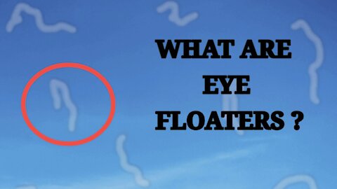 What is eye floaters?