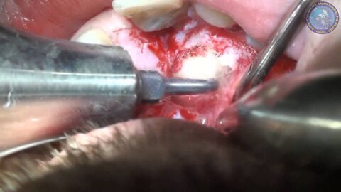 Wisdom Tooth Removal, Wisdom Tooth Extraction #05