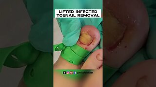 LIFTED DAMAGED/INFECTED TOENAIL REMOVAL 2023 BY FEET DOCTOR MISS FOOT FIXER