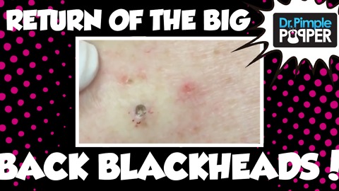 Return, Again, of Big Back Blackheads with Dr. Pimple Popper