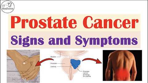 Prostate Cancer Signs and Symptoms (Urinary, Sexual & Metastatic Symptoms)