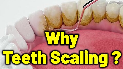 Why scaling is Needed for your Teeth? | Dr. Bharadwaz | Dr. Gopikrishna