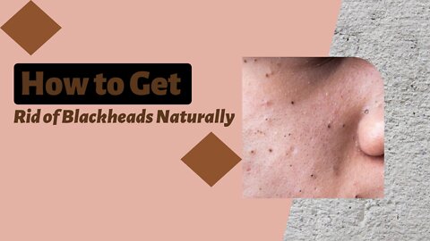 How to Get Rid of Blackheads Naturally