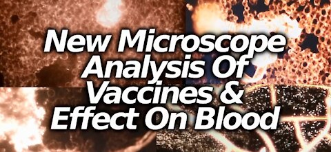 Horrifying Microscope Analysis of J&J Vaxx and the Effects on the Blood