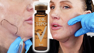 Facial Fat Dissolving Injections - Dr Lipo V - Treatment 3 of 4