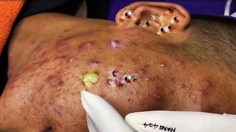 Blackheads Removal & Pimple Popper Cystic Acne Extraction Whiteheads Pimple Popping videos 104