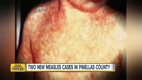 2 more measles cases reported in Pinellas County