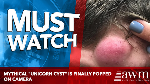 Mythical "Unicorn Cyst" Is Finally Popped On Camera