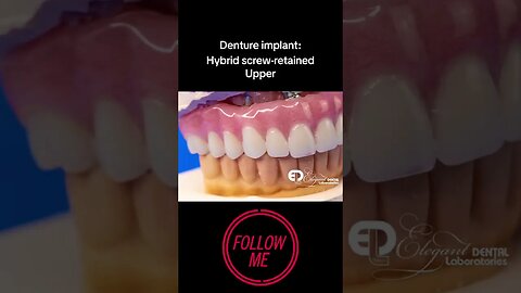 Denture Implant Showcase