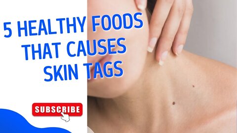 5 Healthy Foods That Cause Skin Tags - What to Avoid