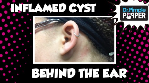 Incision & Drainage of Inflamed Cyst behind left ear