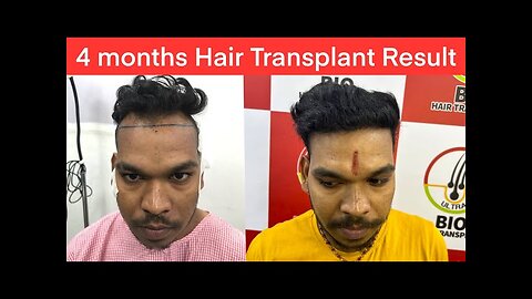 4 Months Hair Transplant Result