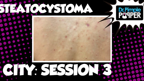 Steatocystoma City, Session 3