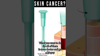 Early Stage Skin Cancer Signs [Skin Cancer Biopsy & Moh's Surgery]