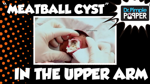 A huge cyst like a DOORKNOB: Hard boiled eggs, anyone?