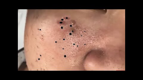 Complete the face easily, acne treatment || How to remove pimples, extract blackheads.