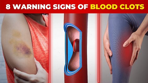 Legs Throbbing? ⚠️ BEWARE THE 8 Warning Signs of BLOOD CLOTS in your Legs