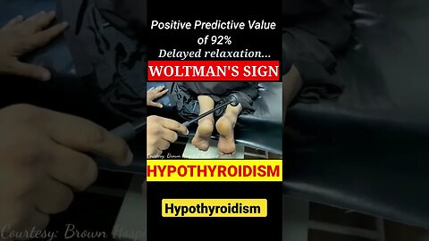 Woltman's Sign of Hypothyroidism #shorts #woltman #sign #hypothyroidism