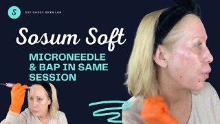 Sosum Soft 🤗 2 Procedures