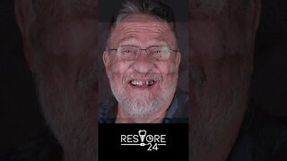 Tim S Restore in 24 Smile Makeover