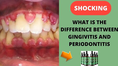 What's the Difference Between Gingivitis and Periodontitis? l How to cure dental disorder