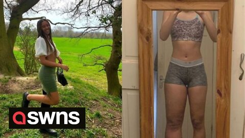 Meet the woman whose left leg is more than double the size of her right one due to a rare condition