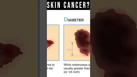 What Does Skin Cancer Look Like? [Symptoms, Pictures, Types]