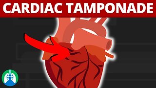 Cardiac Tamponade (Medical Definition) | Quick Explainer Video